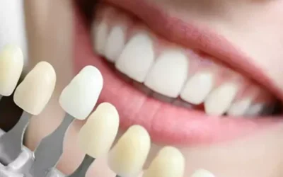 Porcelain Veneers vs. Composite Veneers: Which Is Right for You?