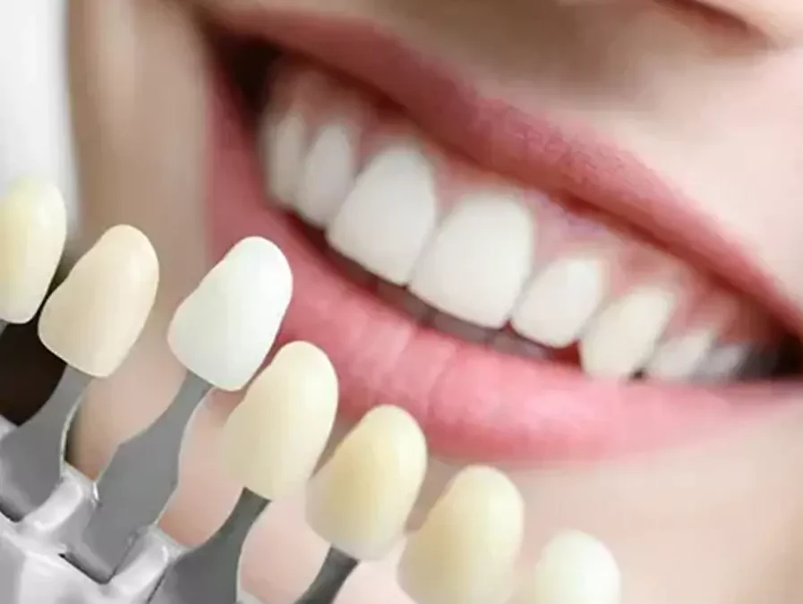 veneers