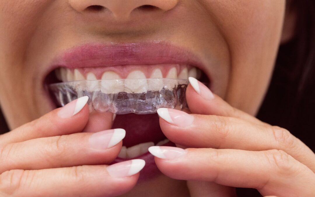 10 Things Your Dentist Wants You to Know Before Starting Invisalign